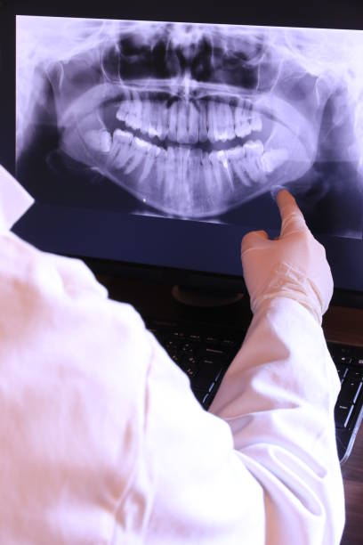Best Knocked-Out Tooth (Avulsed Tooth) Treatment in Bellmore, NY